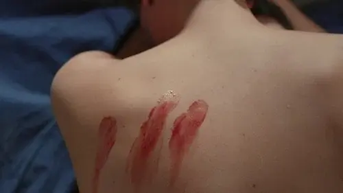 Wound